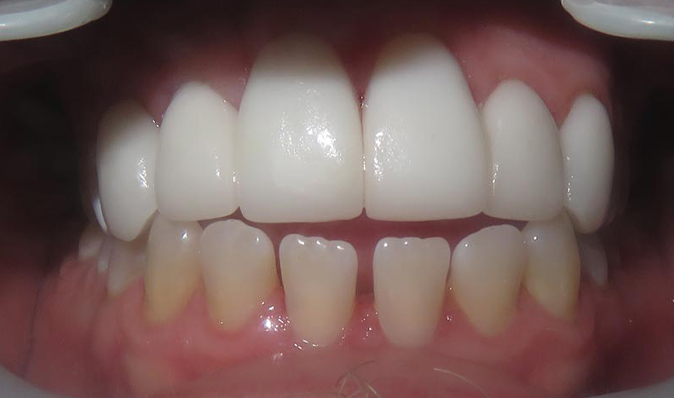 after image of a patient's teeth prior to visiting the dentist in Seminole, FL