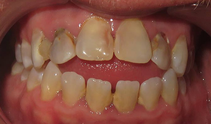 before image of a patient's teeth prior to visiting the dentist in Seminole, FL