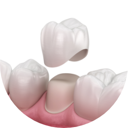 dental crowns