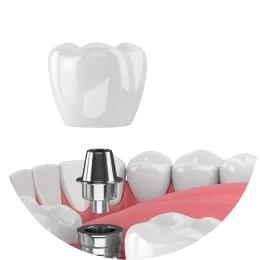 dental implants