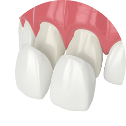 dental veneers